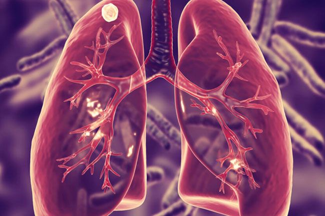 Tuberculosis on the rise in Kandy: 50 cases reported so far in 2024