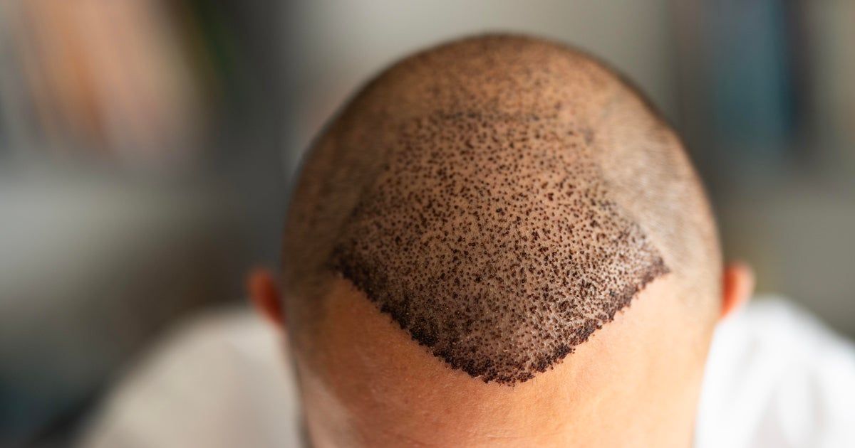 Thinking of a hair transplant? Here’s where many Americans are heading.