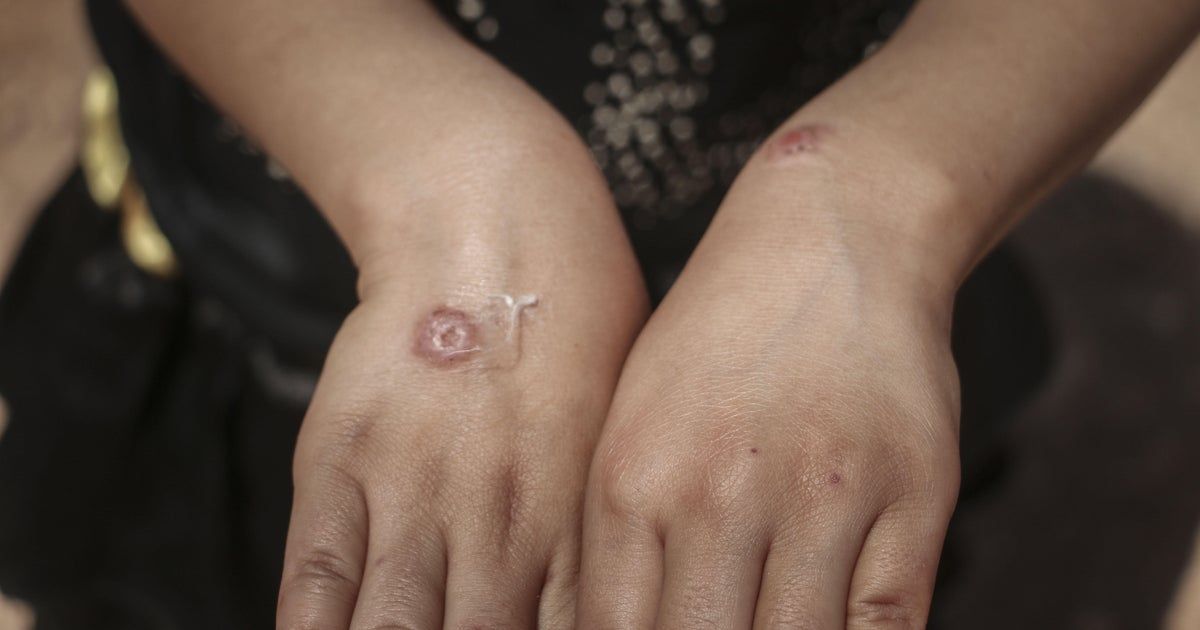 This flesh-eating parasite spread by sand flies has foothold in U.S., appears to be endemic in Texas, CDC scientists report