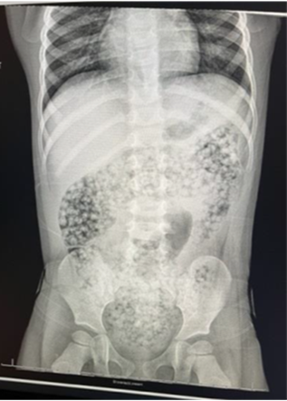 Call for nationwide ban on water beads as parents recount ER visits 1 xray-waterbeads.png