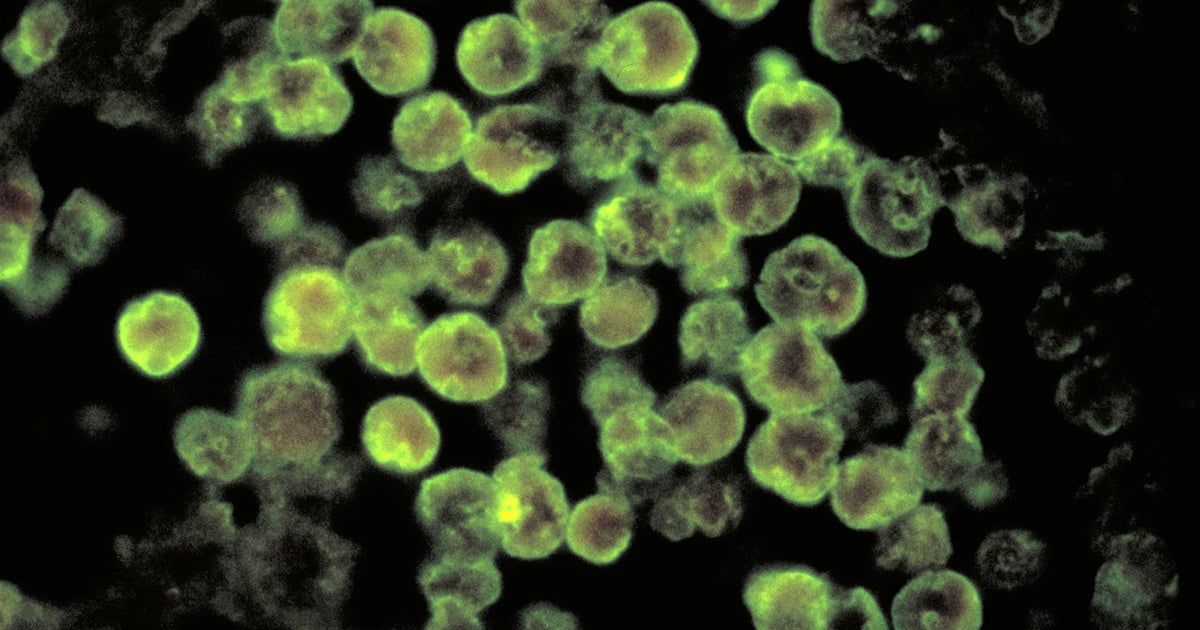 Georgia resident dies from rare brain-eating amoeba,