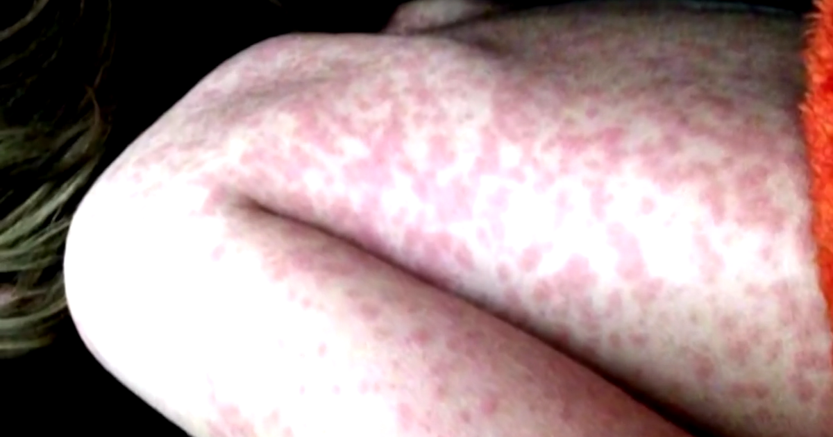 4 cases of measles now confirmed at Chicago migrant shelter, including CPS student