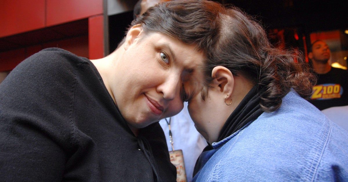 Lori and George Schappell, the world’s oldest living conjoined twins, dead at 62 Lori and George Schappell, the world’s oldest living conjoined twins, dead at 62