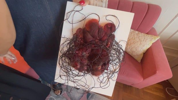 Penn Medicine nurse leans on art as she weaves her way through life, health care 1 aneursm.jpg