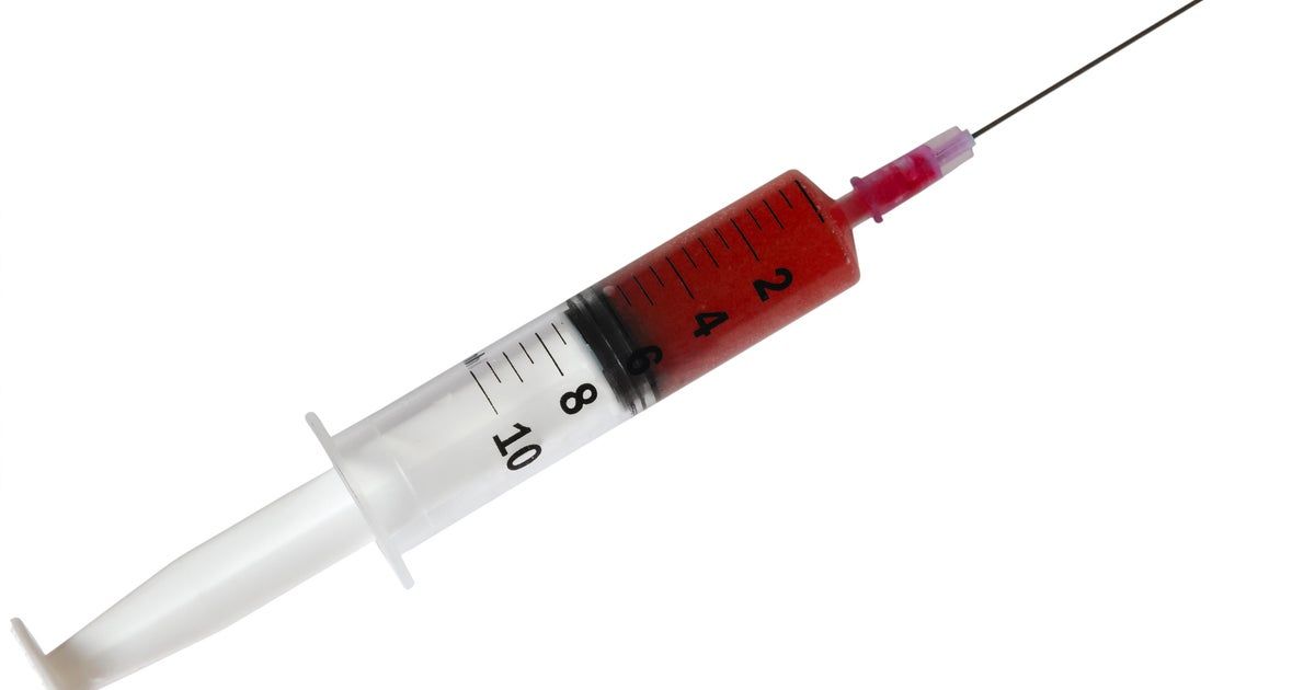 “Vampire facials” at an unlicensed spa infected three people with HIV, CDC finds “Vampire facials” at an unlicensed spa infected three people with HIV, CDC finds