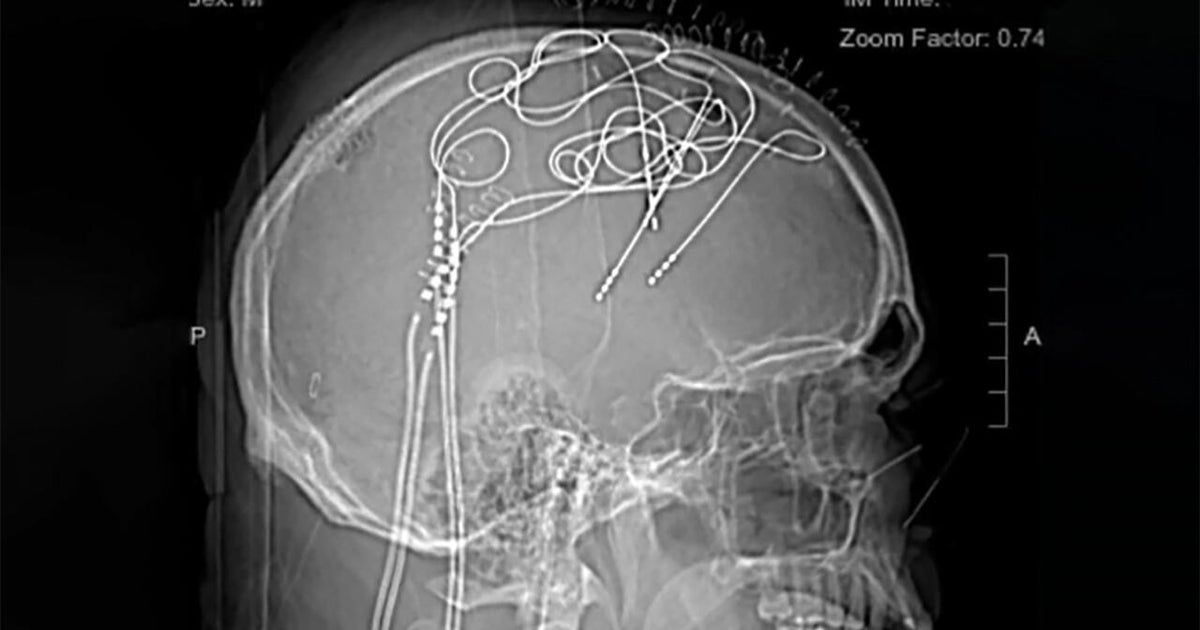 Dr. Sanjay Gupta on the mysteries of chronic pain Dr. Sanjay Gupta on the mysteries of chronic pain