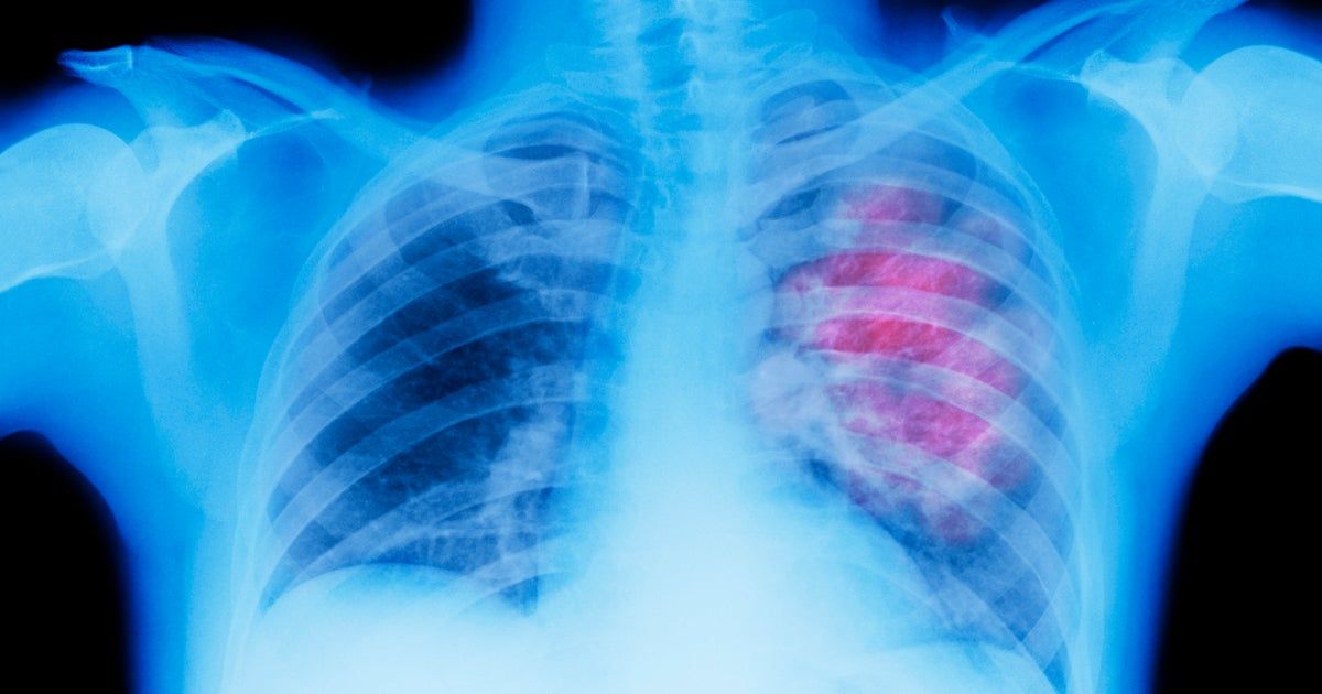Lung cancer mystery: Why are healthy, non-smoking, Asian women contracting the disease?