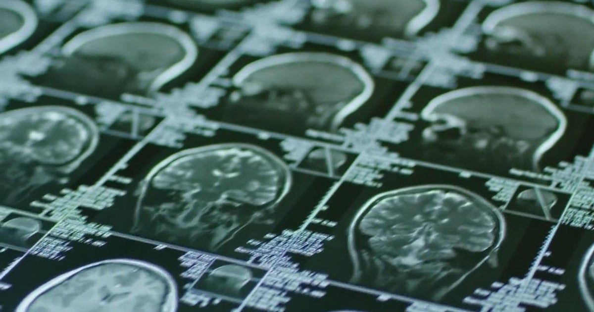Research suggests COVID-19 affects brain age and IQ score Research suggests COVID-19 affects brain age and IQ score