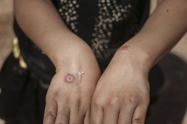 Leishmaniasis disease spreads in refugee camps in Syria