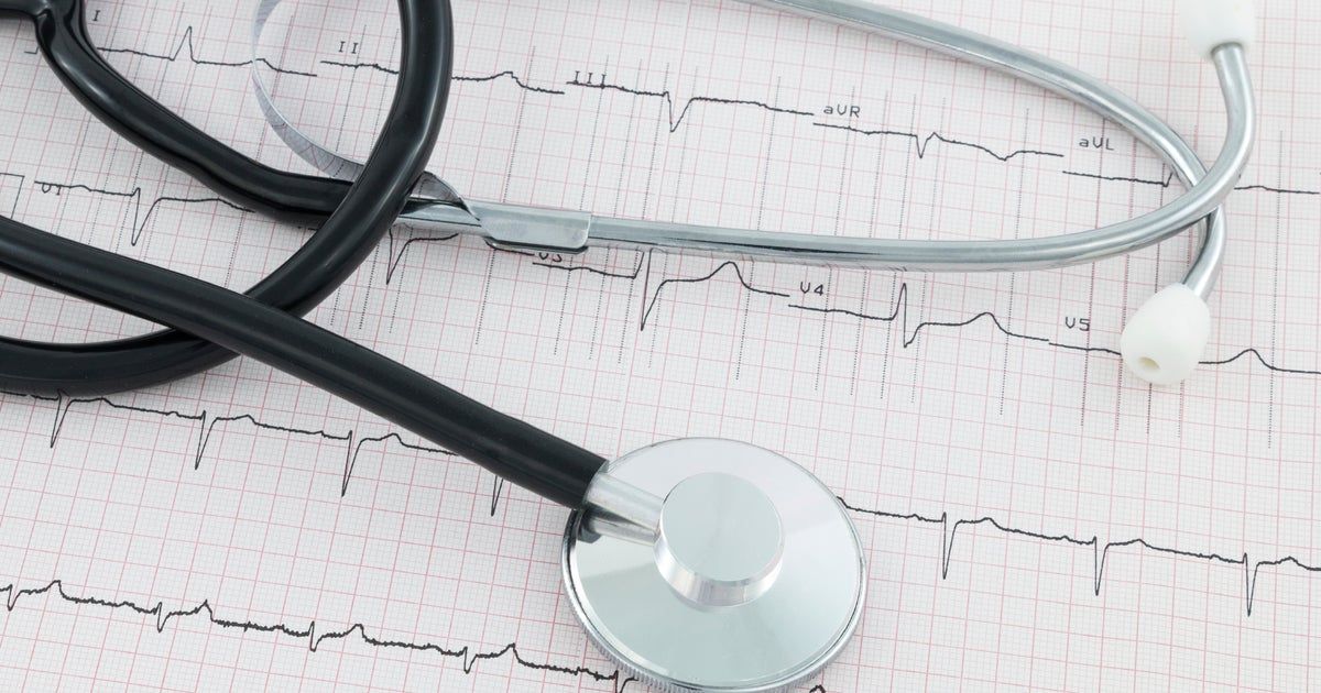 Data shows strokes are more common in African Americans