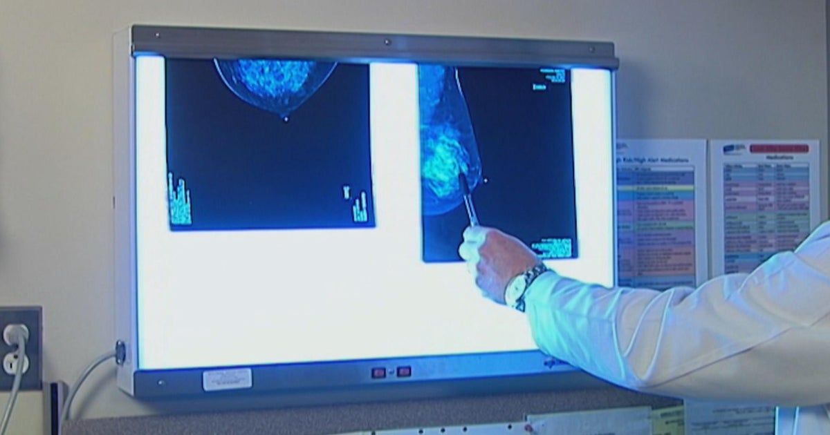 Breast cancer survivor fights with insurance company over annual diagnostic mammograms ordered by the doctor