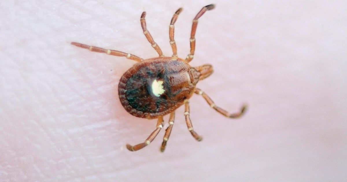 1st death linked to alpha-gal syndrome, a meat allergy spread by ticks, reported in N.J., researchers say