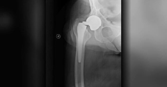 Titanium hip implants snapped in hundreds of people, took years before some products recalled Titanium hip implants snapped in hundreds of people, took years before some products recalled