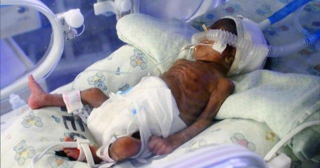 Addressing America’s high premature birth rate