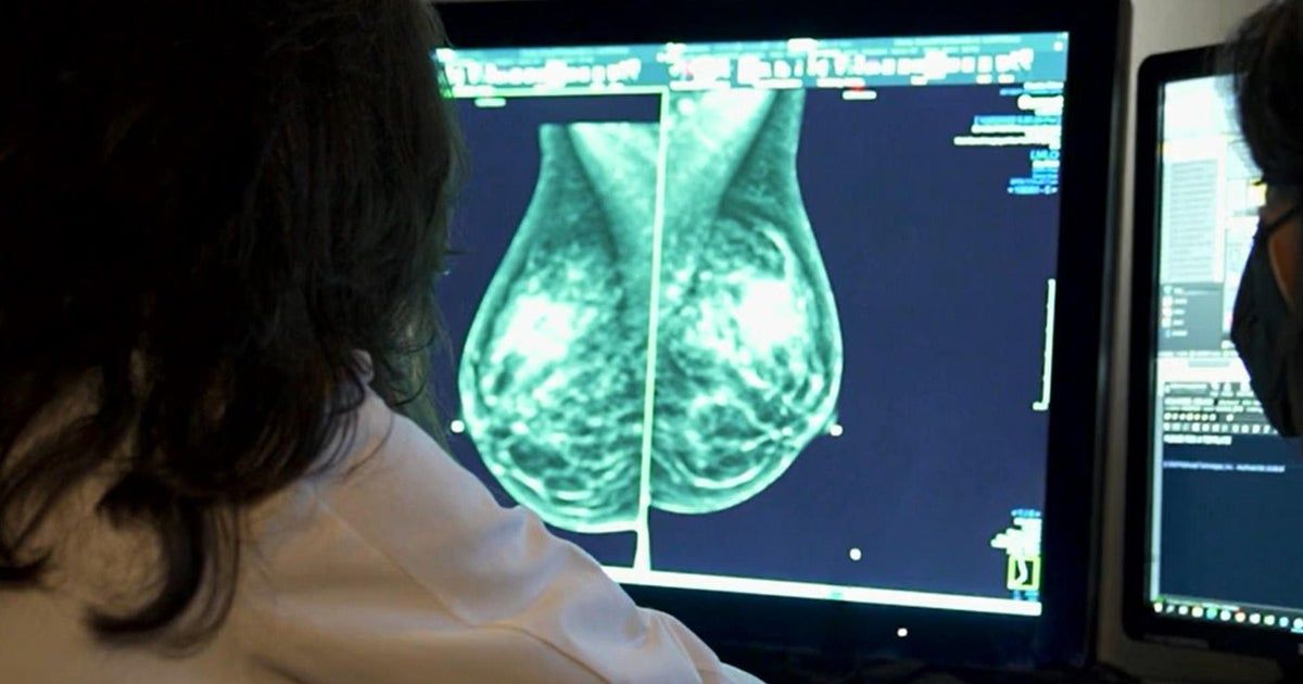 After backlash, feds cancel plan that risked limiting breast reconstruction options after cancer