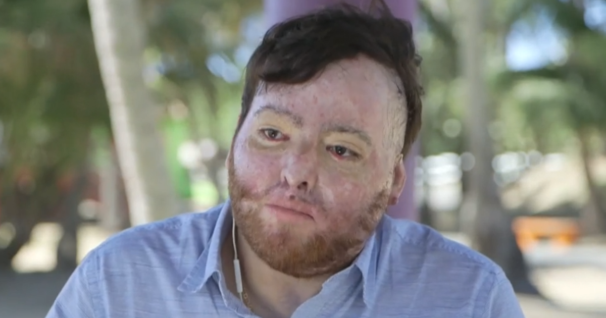 U.S. citizen billed .7 million by government for life-saving burn treatment: