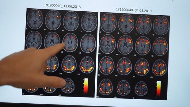 hbot-brain-scans.jpg