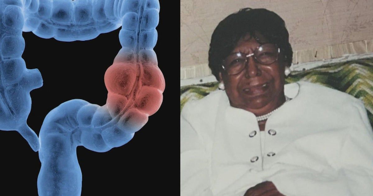 Colon cancer disproportionately impacts Black Americans, but new campaign wants to close the gap
