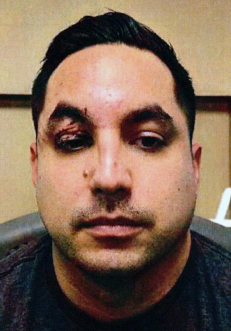 Passenger stabs fellow traveler with weapon of pens and rubber bands on Seattle-to-Vegas flight 1 The passenger with the eye injury.