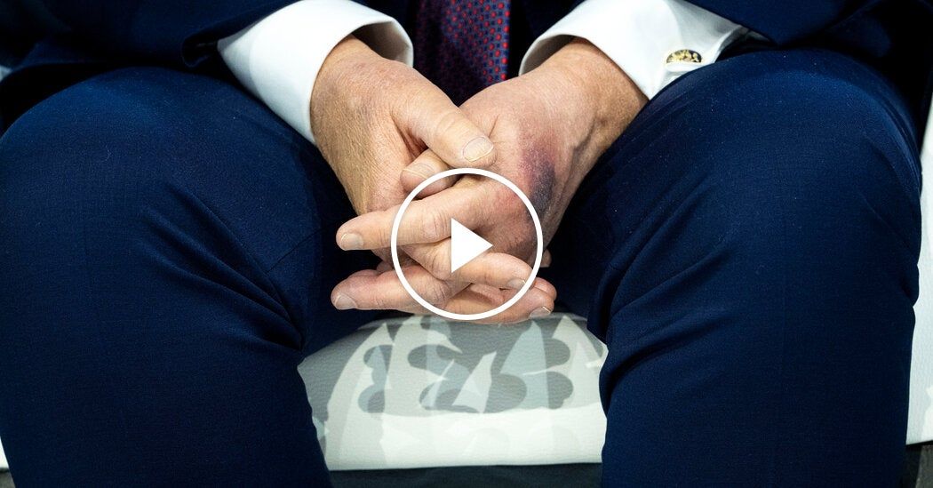Video: Trump Links Bruise on Hand to Aspirin